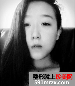 割双眼皮多久恢复自然 北京京美割双眼皮案例