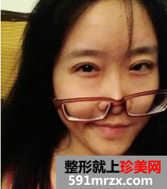 割双眼皮多久恢复自然 北京京美割双眼皮案例