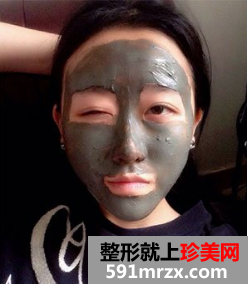 割双眼皮多久恢复自然 北京京美割双眼皮案例