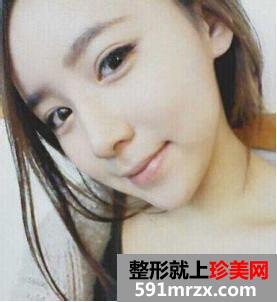 鼻尖肥大整形+鼻翼缩小前后对比 不再是“猪鼻子”