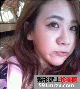鼻尖肥大整形+鼻翼缩小前后对比 不再是“猪鼻子”