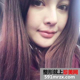 假体垫下巴恢复过程图 北京二炮假体垫下巴