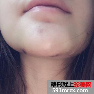 假体垫下巴恢复过程图 北京二炮假体垫下巴
