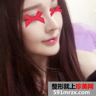 假体垫下巴恢复过程图 北京二炮假体垫下巴