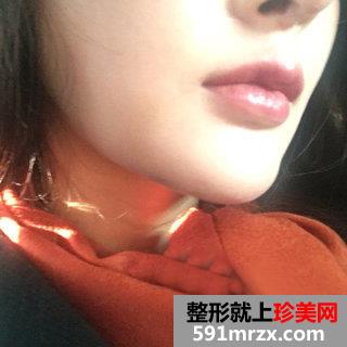 假体垫下巴恢复过程图 北京二炮假体垫下巴
