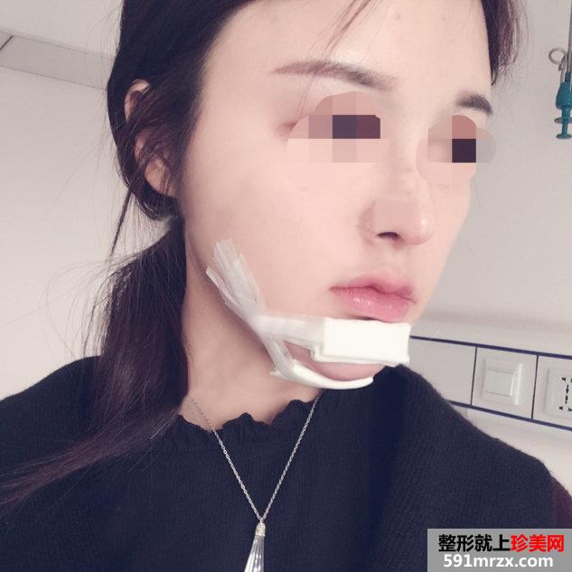 假体垫下巴恢复过程图 北京二炮假体垫下巴