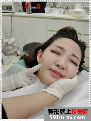 瘦脸前后效果对比图