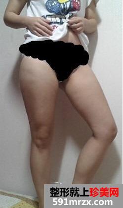 腿部吸脂+自体脂肪丰臀手术后恢复经历