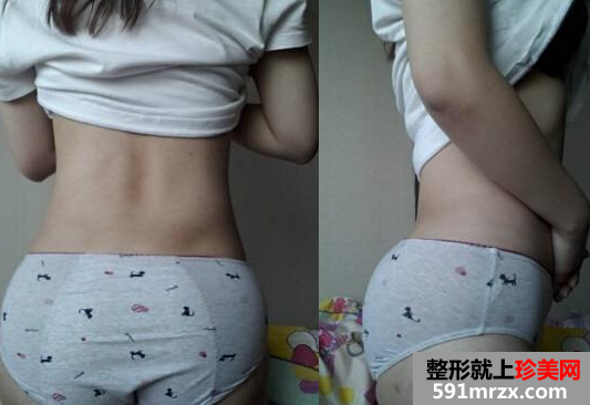 腿部吸脂+自体脂肪丰臀手术后恢复经历