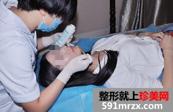 冰点脱唇毛 告别难看的小胡子