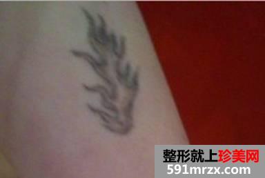 激光洗纹身后的效果图