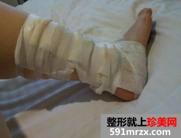 激光洗纹身后的效果图