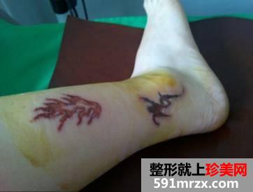 激光洗纹身后的效果图