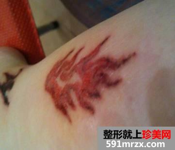 激光洗纹身后的效果图