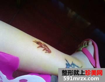 激光洗纹身后的效果图