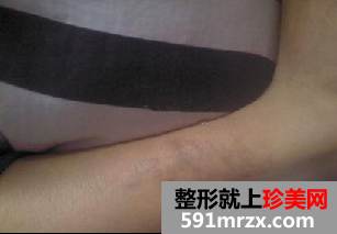 激光洗纹身后的效果图