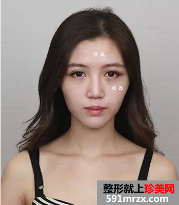 玻尿酸丰额头和苹果肌整形经历