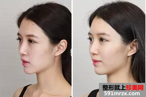 玻尿酸丰额头和苹果肌整形经历