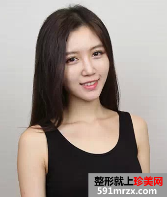 玻尿酸丰额头和苹果肌整形经历