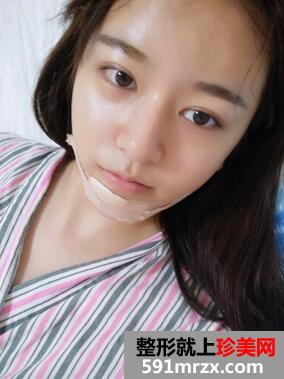硅胶假体垫下巴手术前后对比效果图和恢复过程