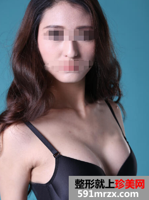 自体脂肪隆胸我的真实经历