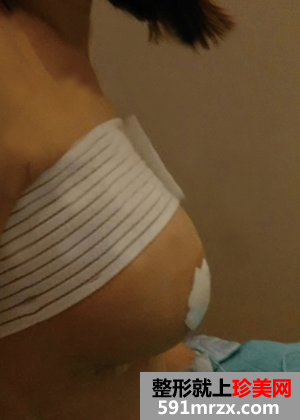 自体脂肪隆胸我的真实经历
