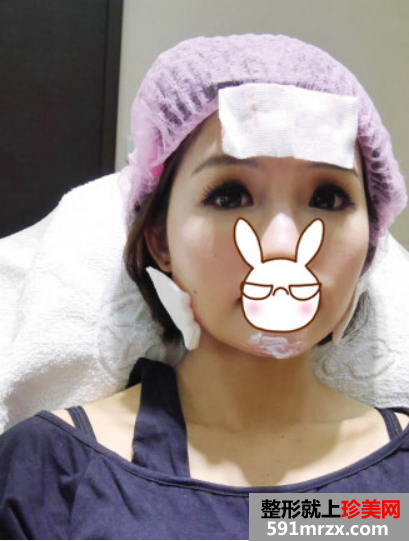 熬过怀孕哺乳期 我来到成都赵博士整形美容打瘦脸啦