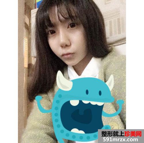 上海华美脂肪填充