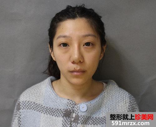上海华美脂肪填充