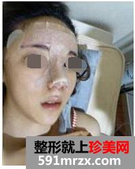 　　硅胶隆鼻手术+耳软骨垫鼻尖+缩鼻翼 现在的我自信多了。开始这个悲催的话题需要定的勇气…怎么说呢?额，其实这篇帖子是我做硅胶隆鼻手术+耳软骨垫鼻尖+缩鼻翼半年时间的记录帖子。  　　手术前不敢照镜子，特别是鼻子、我自己觉得很难看的!我给你们发几张以前的照片：    　　是不是鼻子特不好看呀? 鼻翼大、鼻头那么圆、还有鼻梁超低  　　下面让你们看下我从手术室出来在病房就照的张照片：  这篇帖子是我硅胶隆鼻+鼻尖软骨+鼻翼缩小+吸脂半年时间的记录帖子。  　　怎么样? 鼻子是不是有很明显的变化呀!嘻嘻  　　再来上张拆线后恢复期间的照片：  贴吧分享：郑州硅胶隆鼻+鼻尖软骨+鼻翼缩半年啦!  　　下面再来基本恢复的照片  贴吧分享：郑州硅胶隆鼻+鼻尖软骨+鼻翼缩半年啦!  　　鼻子变高了，脸部也有立体感了，皮肤也变好了~  　　现在不打扮也好漂亮的!哈哈  　　朋友们也都羡慕我的变化的～呵呵  贴吧分享：郑州硅胶隆鼻+鼻尖软骨+鼻翼缩半年啦!  　　这是我现在的面貌，看起来怎么样呢?漂亮吗?  　　以上内容就是对做了手臂吸脂3个月了 减肥到25cm了的介绍，希望对你有所帮助。若有疑问或想了解更多整形美容方面的信息，欢迎咨询我们的在线专家，他们将为你提供最优质的服务。