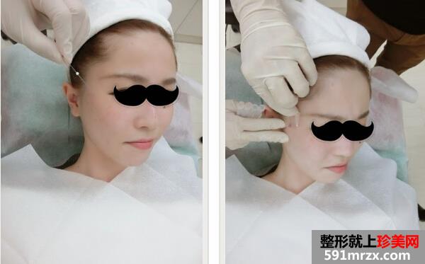 埋线提拉手术恢复前后对比图
