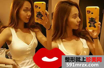 自体脂肪,丰胸,手术,恢复,过程,效果图