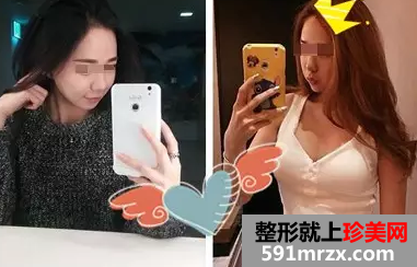 自体脂肪,丰胸,手术,恢复,过程,效果图