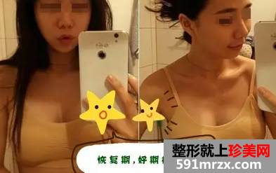 自体脂肪,丰胸,手术,恢复,过程,效果图