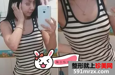 自体脂肪,丰胸,手术,恢复,过程,效果图