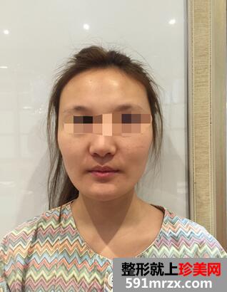 韦敏做的颧骨内推，脸变小了好开心【诗颜网案例】
