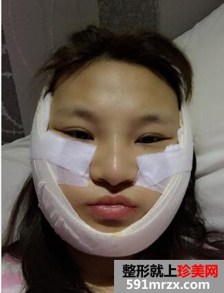 韦敏做的颧骨内推，脸变小了好开心【诗颜网案例】