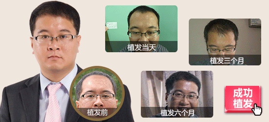 发际线,移植,前后,对比,效果,图片