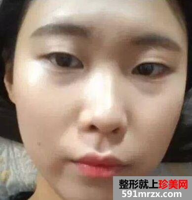 广州美莱开双眼皮前后对比照