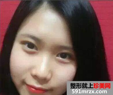 广州美莱开双眼皮前后对比照