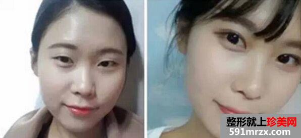 广州美莱开双眼皮前后对比照