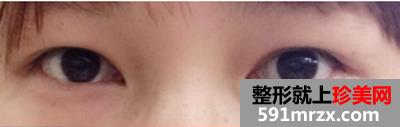 广州美莱整形割双眼皮效果怎么样