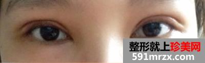 广州美莱整形割双眼皮效果怎么样