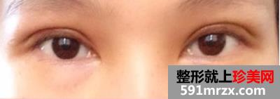 广州美莱整形割双眼皮效果怎么样