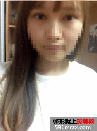 广州美莱整形割双眼皮效果怎么样
