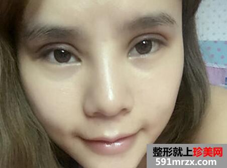 做了生物焊接双眼皮 他们都说我像洋娃娃