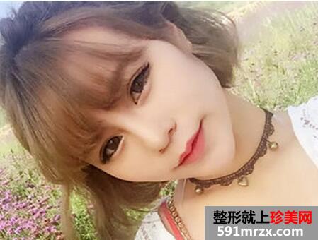做了生物焊接双眼皮 他们都说我像洋娃娃
