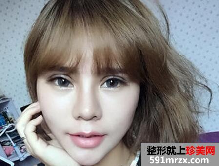 做了生物焊接双眼皮 他们都说我像洋娃娃