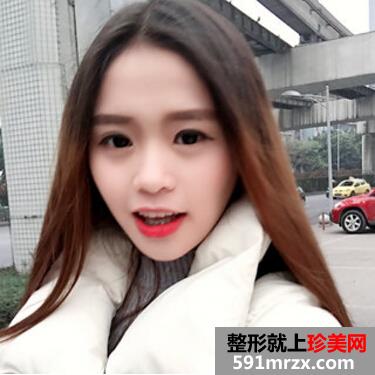 硅胶假体隆鼻好吗 看看我的变化就知道了