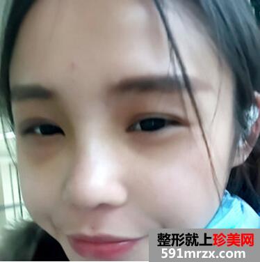 硅胶假体隆鼻好吗 看看我的变化就知道了